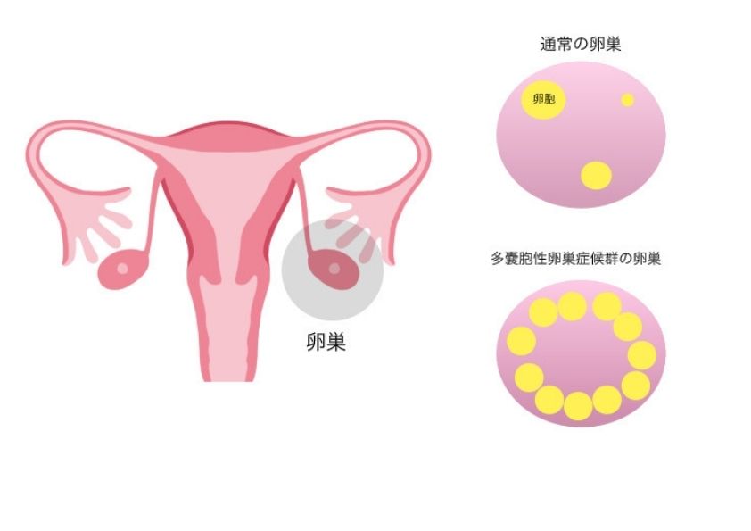 PCOSの卵巣